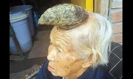 Chiếc sừng to trên đầu cụ Liang Xiuzhen