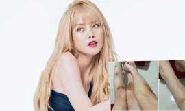 “Bạn gái tin đồn” Sơn Tùng M-TP đăng ảnh tay chân xước xát nặng nề khiến fan lo lắng