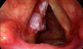 Phẫu thuật thành công cho 32 bệnh nhân ung thư thanh quản bằng laser