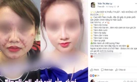 Tiêm filler: Sau công dụng 'thần tiên', làm nhanh giá rẻ là ẩn họa khôn lường!