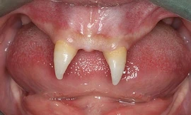 Cậu bé mọc răng như ma cà rồng