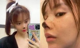 Showbiz 12/4: Nữ diễn viên xinh đẹp bị ‘biến dạng’ mặt vì phẫu thuật thẩm mỹ