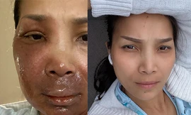 Hồng Ngọc khoe ảnh mặt mộc sau sự cố nổ nồi hơi gây biến dạng tại Mỹ
