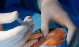 Nguyên nhân dẫn tới tử vong ở người bệnh được chẩn đoán là do ngộ độc thuốc tê (ảnh minh họa)