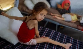 Jana Ayad, một bé gái Palestine bị suy dinh dưỡng, được điều trị tại bệnh viện dã chiến của Quân đoàn Y tế Quốc tế ở phía nam Dải Gaza ngày 22/6/2024. Ảnh: Reuters