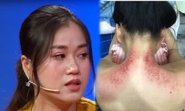 Tung ảnh vai gáy đỏ mẩn, Lâm Vĩ Dạ làm fans lo lắng