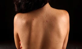 Bác sĩ chỉ cách điều trị mụn trứng cá ở lưng 