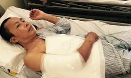 Cánh tay phải của bệnh nhân Hoàng Văn Nhân đã bị cắt đi phần da hoại tử.