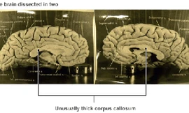 Mô tả phần vỏ não Albert Einstein trong nghiên cứu của Dean Falk năm 2013. Ảnh: BBC.