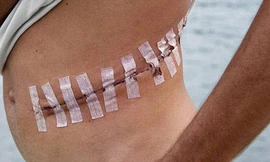 Một nạn nhân sau khi bị IS mổ lấy gan nhưng may mắn sống sót.