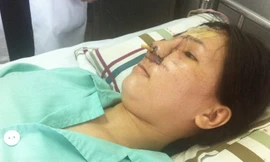 Chị Phú sau khi được phẫu thuật tái tạo gương mặt do bị bom nổ. Ảnh: Quốc Ngọc.