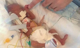 Bé Mollie chào đời thiếu tháng, chỉ nặng chưa đầy 0,5 kg. Ảnh: Health.