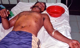 Điểu Huy, người bị thương nặng nhất trong 4 nạn nhân vụ nổ quả đạn. Ảnh: Minh Hưng.