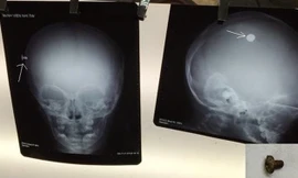 Hình ảnh chiếc đinh vít (đốm trắng) trên phim X quang hộp sọ chụp thẳng và chụp nghiêng và sau khi được gắp ra khỏi đầu bệnh nhi (ảnh dưới phải). Ảnh do bác sĩ cung cấp.