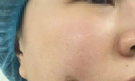 Người phụ nữ bị nhiễm trùng sau khi làm má lúm đồng tiền