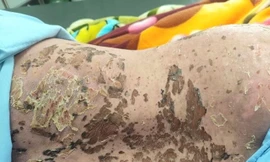 Thanh Hoá: Suýt mất mạng vì tự dùng thuốc nam