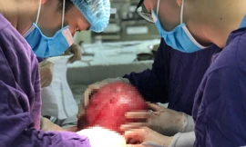 Các bác sĩ BV Ung bướu Hà Nội phẫu thuật cho bệnh nhân mang khối bướu khổng lồ. Ảnh: BV cung cấp