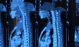 Hình ảnh phim chụp khối u tuyến ức lạc chỗ