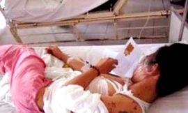 Học sinh lớp 10 bị tạt axít ngay tại nhà