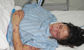 Bệnh nhân T. đang được điều trị tại Bệnh viện Bệnh Nhiệt đới T.Ư. Ảnh: BS Nguyễn Trung Cấp