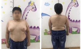Bé trai 13 tuổi tăng cân mất kiểm soát sau khi lạm dụng thuốc corticoid Ảnh: T.Hà 