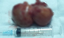 Phẫu thuật thành công nang màng tim 'khủng', hiếm gặp