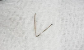 Lấy thành công đoạn kim loại 7cm trong cổ họng bé gái 5 tuổi