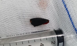 Gỡ hạt hồng xiêm nằm vắt ngang trong phế quản cô gái suốt 27 năm