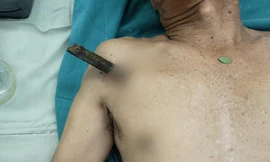 Ngã xe đạp, cụ ông 70 tuổi bị thanh gỗ dài 30cm đâm thủng phổi