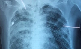 Phổi ngập đầy bùn vì đuối nước, cô gái may mắn thoát chết