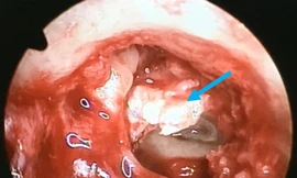 Bé gái suýt bị điếc vì khối cholesteatoma ăn mòn xương con trong tai giữa