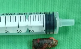 Lấy đầu viên đạn nằm trong cơ thể người đàn ông suốt nửa thế kỉ