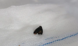 Suýt chết vì 'bỏ quên' hạt vú sữa trong phổi hàng tháng trời