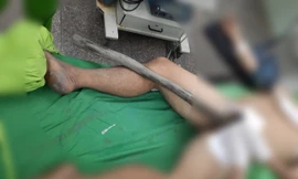 Người đàn ông mang cả cây gỗ xuyên từ tầng sinh môn đến bụng nhập viện