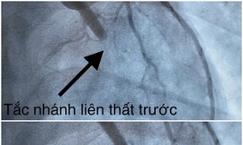 23 tuổi, nam thanh niên đột quỵ vì hút thuốc và nhậu trong nhiều năm