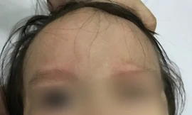 Bé gái 17 tháng tuổi đột ngột liệt mặt sau khi chảy mũi, ngạt mũi