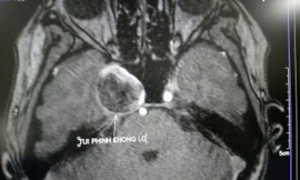 Cứu cụ bà có túi phình não khổng lồ mà không cần phẫu thuật