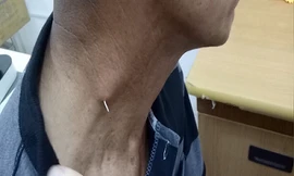 Gắp xương cá đâm xuyên da cổ một cụ ông