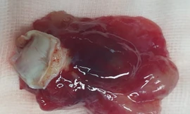 Khối u tim to bằng quả trứng, nữ bệnh nhân may mắn thoát cửa tử thần