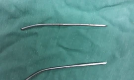 Bị đinh nẹp xương đâm thủng thực quản khí quản sau 2 năm 'bỏ quên'