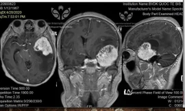 Khối u não khổng lồ của bệnh nhân vừa được SIS phát hiện và cứu nguy