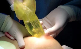 Túi độn ngực được lấy ra (ảnh: BVCC)