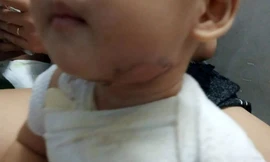 Bé trai bị phỏng nước sôi do gia đình bất cẩn