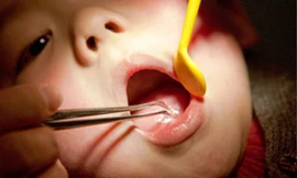 Nhiều trẻ nuốt dị vật do sự bất cẩn của người lớn