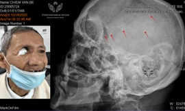 Hàng trăm mảnh đạn li ti nằm trong đầu bệnh nhân 