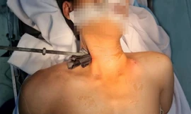 Thanh niên bị cây sắt đâm xuyên cổ (ảnh: BVCC)