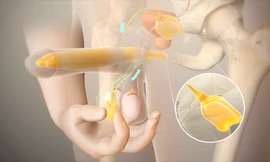 Thiết bị thể hang nhân tạo được xem là cứu cánh cho những bệnh nhân bị rối loạn cương dương khi những giải pháp điều trị thất bại