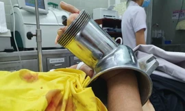 Bệnh nhân bị máy xay thịt nghiền nát bàn tay (ảnh: BVCC)