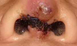 Trụ mũi đứt lìa khi nâng mũi ở bác sĩ "dạo"