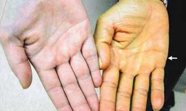 Thay đổi bất thường trên da, coi chừng bệnh nguy hiểm